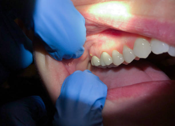 Best Broken or Cracked Tooth Emergency Dentist in Sudden Valley, WA