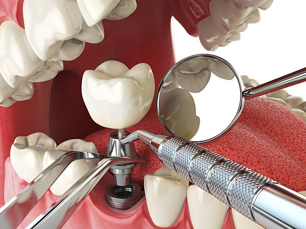 Best Emergency Dentist for Knocked-Out Tooth in Sudden Valley, WA